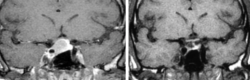 MRI Pituitary pre and post-surgery