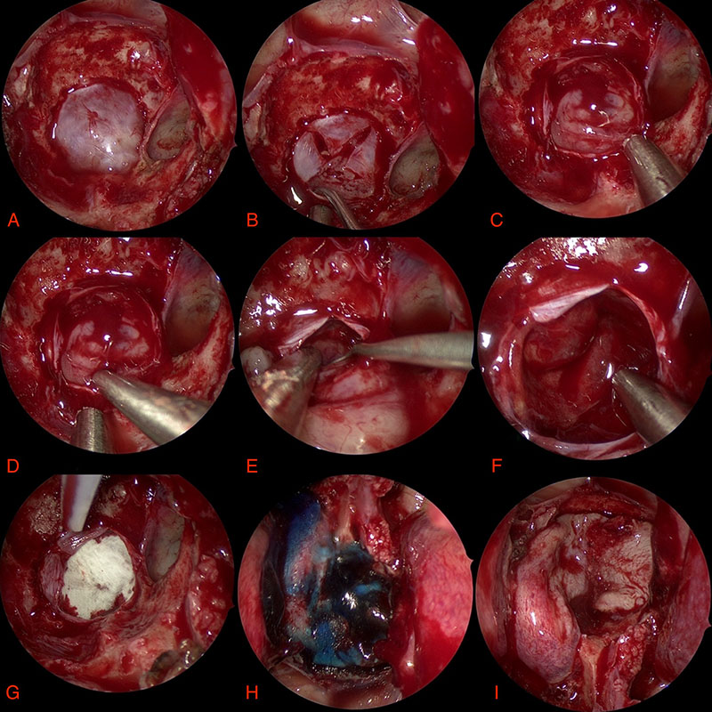 Operation photographs ETSS for pituitary adenoma A Law
